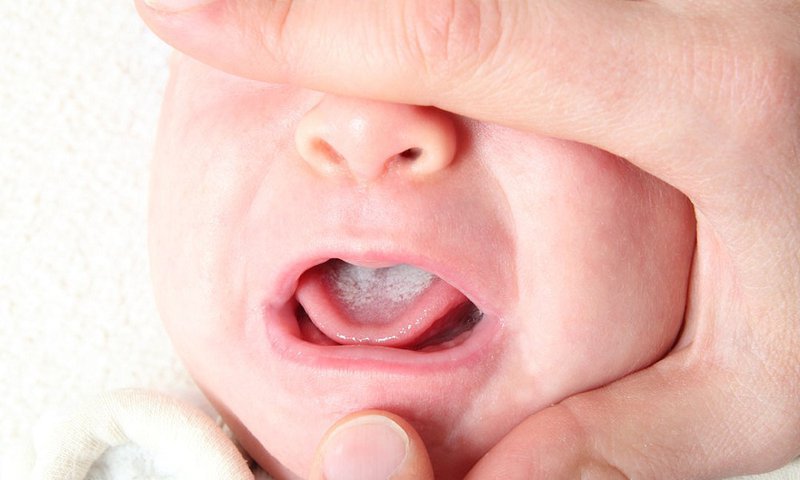 Trẻ 20 tháng tuổi bị nhiệt miệng, không chịu bú phải làm sao?