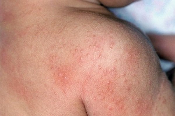 Nổi chấm đỏ dưới da khắp người là dấu hiệu của bệnh gì?