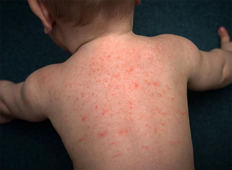 Nổi mẩn khắp người sau sốt là dấu hiệu của bệnh gì?