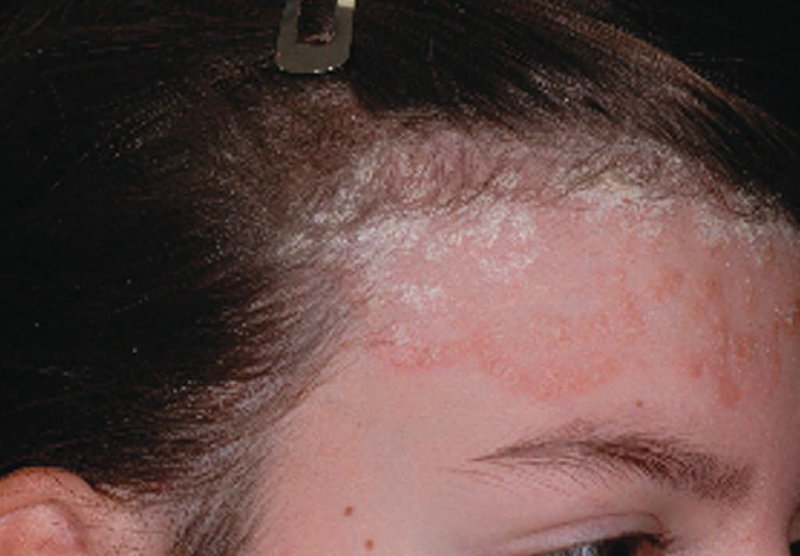Điều trị nấm da đầu khi đang cho con bú như thế nào?