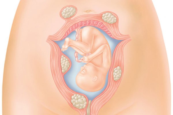 Điều trị nhân xơ tử cung khi mang thai 5 tuần như thế nào?
