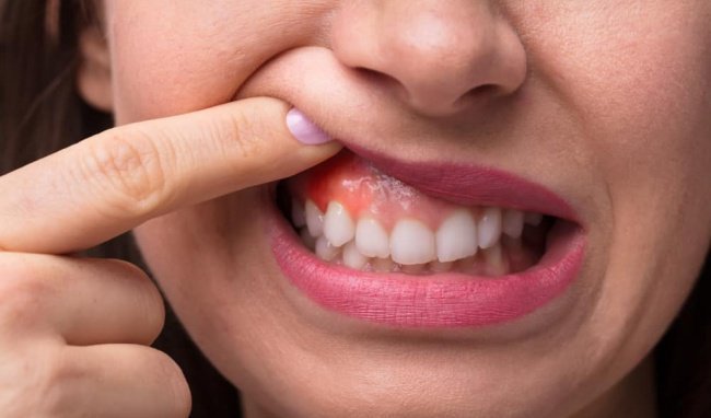 Nữ giới viêm chân răng, sưng lợi điều trị như thế nào?
