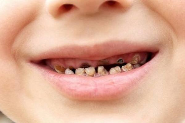 Trẻ sâu răng điều trị như thế nào?
