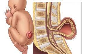 Rối loạn tiểu tiện ở trẻ nứt đốt sống lưng vùng mông điều trị thế nào?
