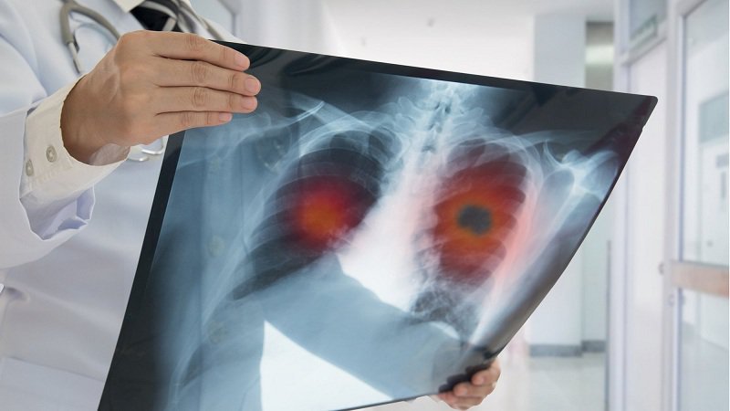 Chẩn đoán các giai đoạn của ung thư phổi