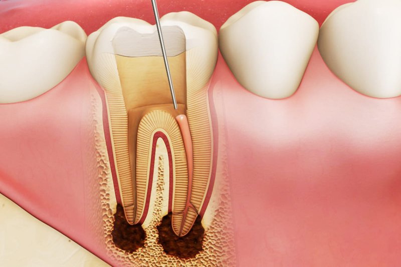 Nam giới đau buốt răng sau khi lấy tủy nguyên nhân là gì?
