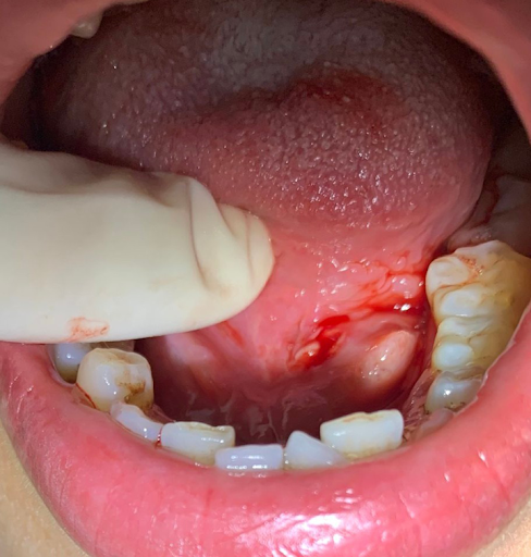 Rỉ máu ở lưỡi do viêm tĩnh mạch lưỡi và ống wharton phải làm gì?