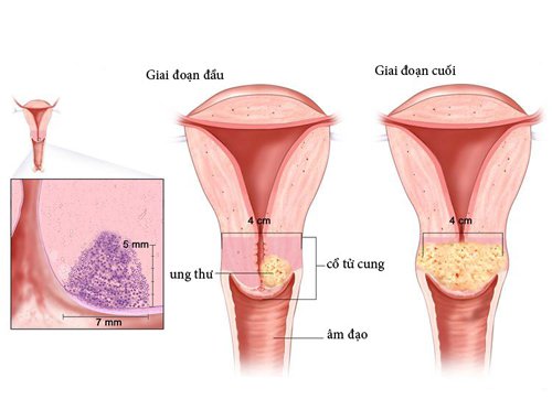 Quan hệ ra máu sau hóa, xạ trị ung thư cổ tử cung là sao?