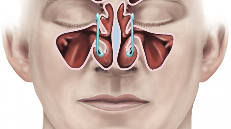 Nam giới ngạt mũi sau phẫu thuật cuốn mũi nguyên nhân là gì?