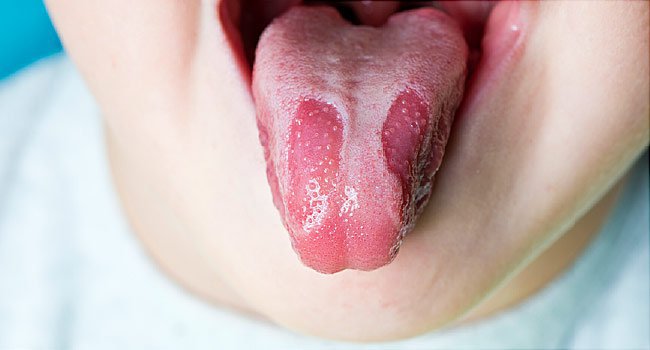Trẻ 24 tháng bị nấm lưỡi kèm loét có nên đi khám không?