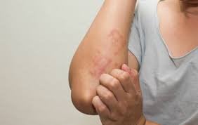 Ngứa cánh tay và ngang đùi vào mùa lạnh là dấu hiệu bệnh gì?