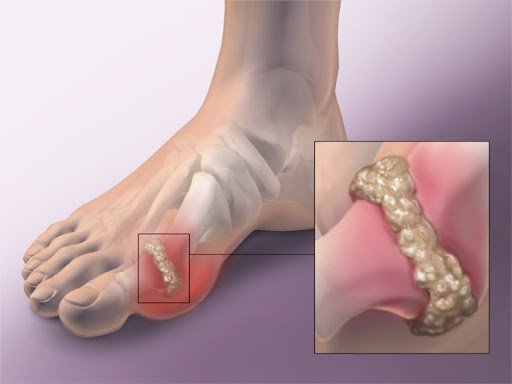 Bệnh Gout là một trong các bệnh cơ xương khớp có thể do béo phì gây ra