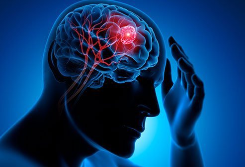 U nguyên bào thần kinh đệm (GBM) não trán trái là gì?