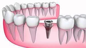 Sau nhổ răng hàm 3 năm có trồng răng implant được không?