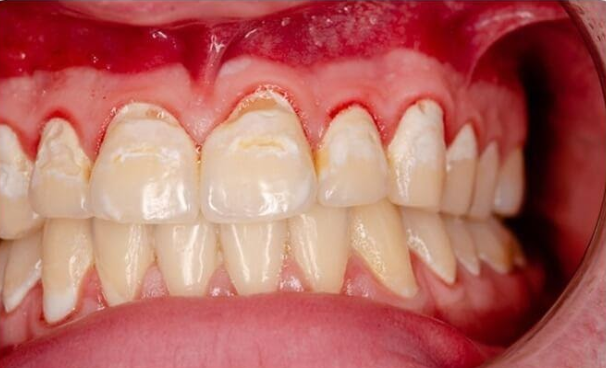 Bị chảy máu chân răng, hôi miệng sau 7 năm thay răng hàm phải làm sao?