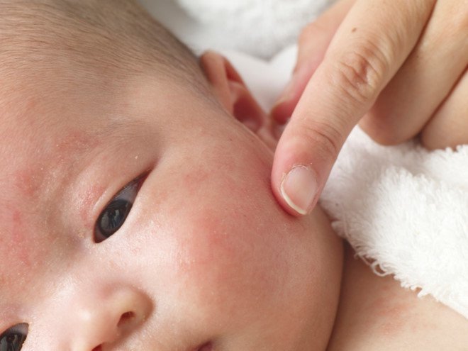 Triệu chứng nổi mẩn đỏ thành tảng ở trẻ sơ sinh có gì bất thường?