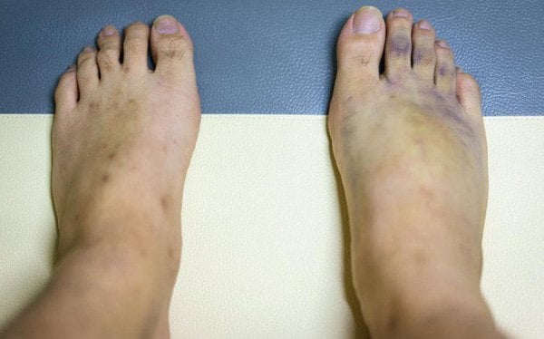 Ngón chân đau nhức kèm bầm tím ở người tiểu đường có sao không?