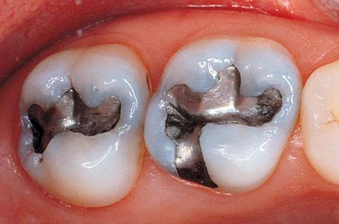 Trám răng composite