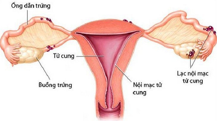 Nữ giới cắt bỏ u lạc nội mạc tử cung, u có di căn không?