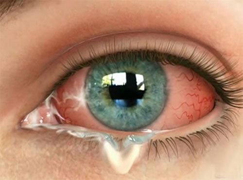 Sau khi uống thuốc trị viêm kết mạc mắt rát cộm kèm nhìn mờ có sao không?