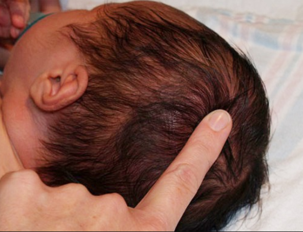 Trẻ 26 ngày tuổi có cục nước mềm trên đầu là bị làm sao?