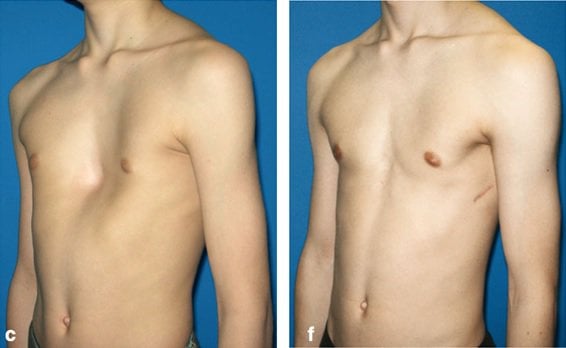 Nam giới 21 tuổi lõm ngực bẩm sinh có điều trị được không?