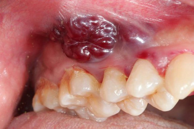 Ung thư nướu răng giai đoạn 4 điều trị bằng phương pháp xạ trị i-ốt có được không?