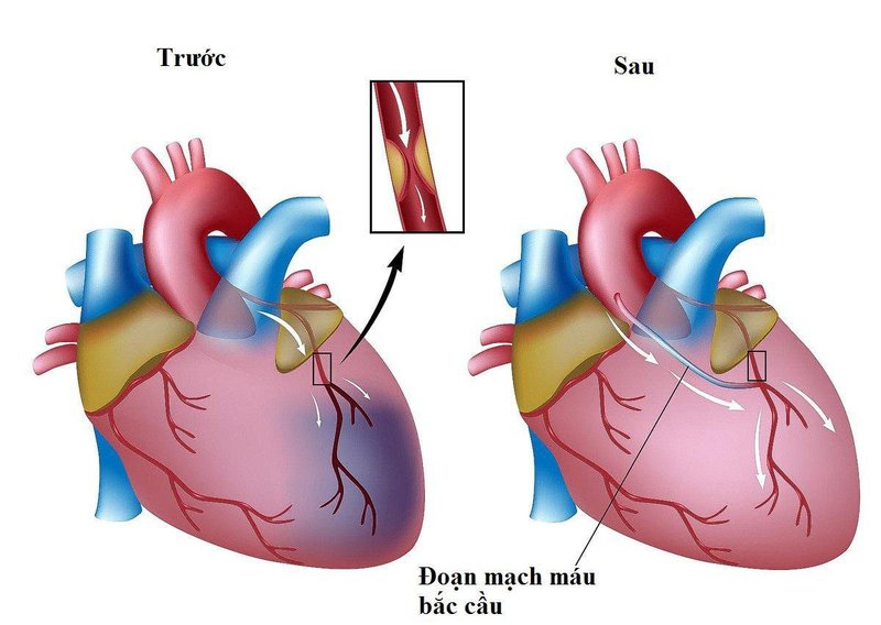 Quy trình phẫu thuật bắc cầu nối động mạch vành thực hiện thế nào?