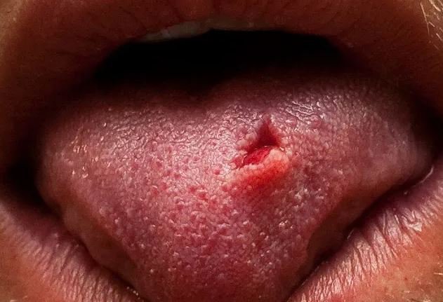 Việc vô tình cắn vào lưỡi có thể gây tổn thương là nguyên nhân gây đau lưỡi