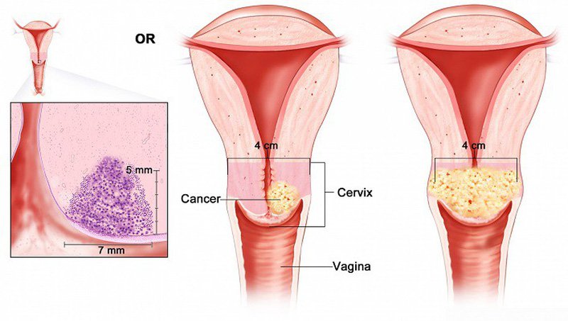 Nữ giới có khối u cổ tử cung 7,4cm nên mổ nội soi không?