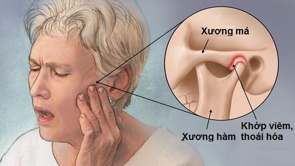 Bị đau quai hàm gần tai có thể do vêm khớp thái dương hàm