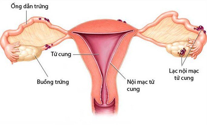 Nữ giới u lạc nội mạc tử cung điều trị như thế nào?