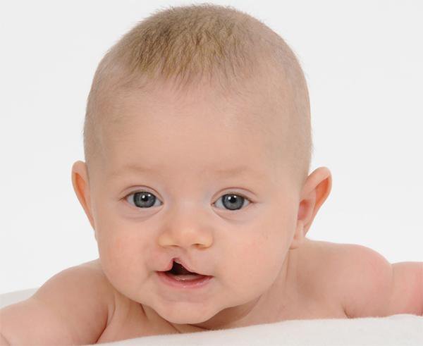 Trẻ sơ sinh bị hở hàm ếch mất bên mũi điều trị được không?