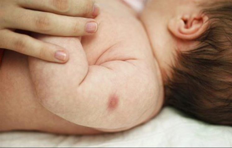 Trẻ nổi mẩn sau tiêm vắc-xin lao có sao không?