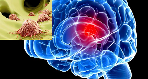 Ung thư di căn não có chữa được không?
