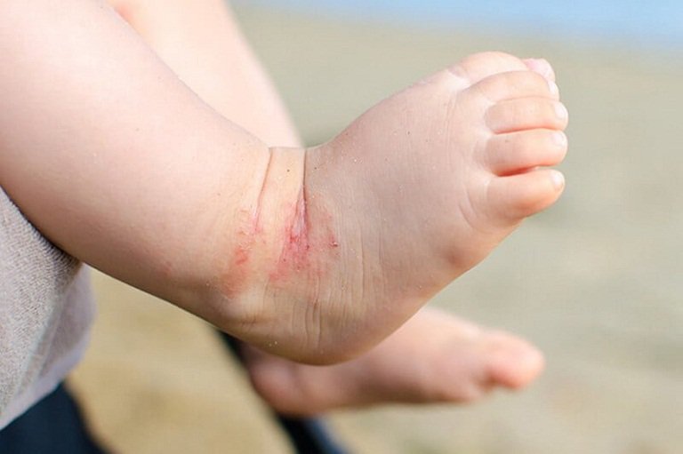 Trẻ 11 tháng chân nổi đốm đỏ lan thành vùng có phải chốc lở không?