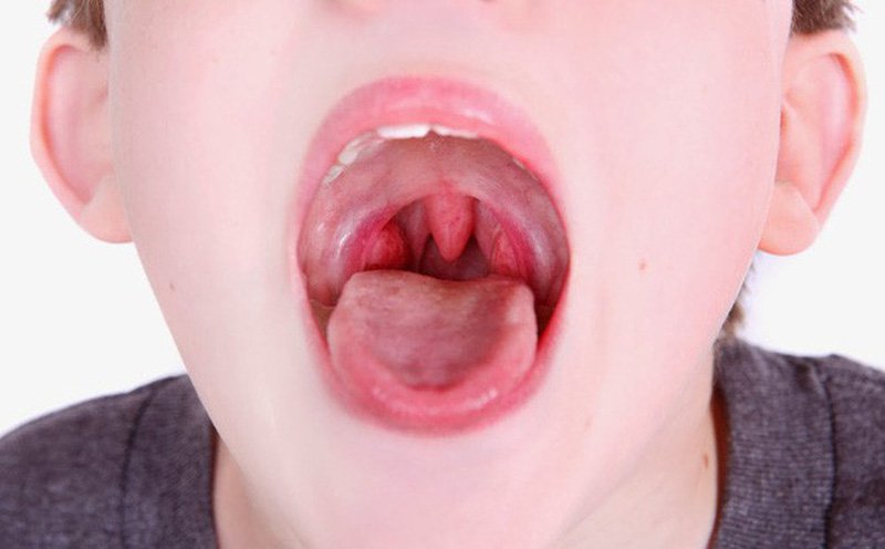 Trẻ 11 tuổi viêm amidan quá phát tái lại nhiều lần có nên cắt không?