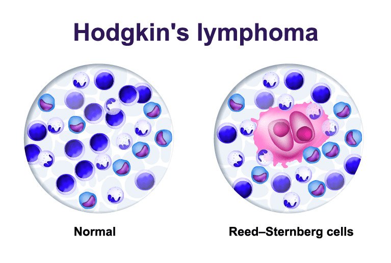 Lympho không Hodgkin tái phát điều trị như thế nào?