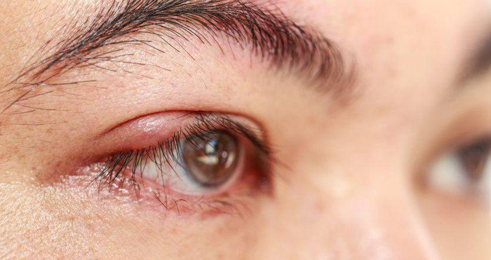Điều trị dứt điểm lẹo mắt như thế nào?