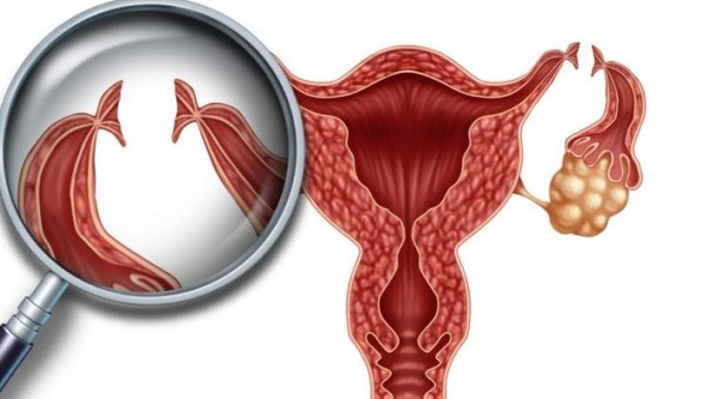 Nữ giới thắt ống dẫn trứng muốn có thai nên làm gì?