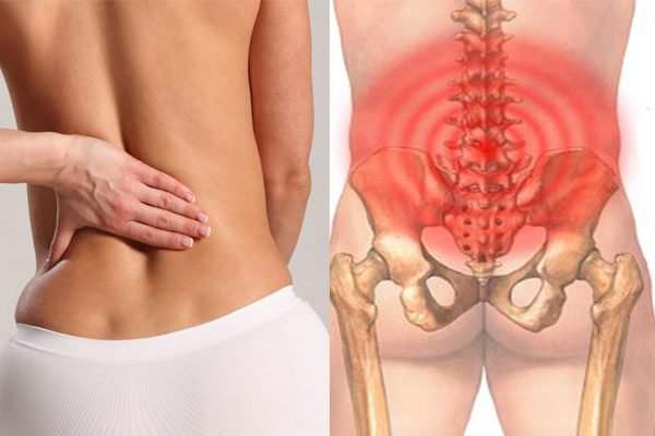Đau lưng dưới gần mông là dấu hiệu bệnh gì?