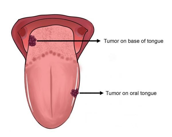 Đau nhức vết thương phẫu thuật ung thư lưỡi giai đoạn 1 phải làm sao?