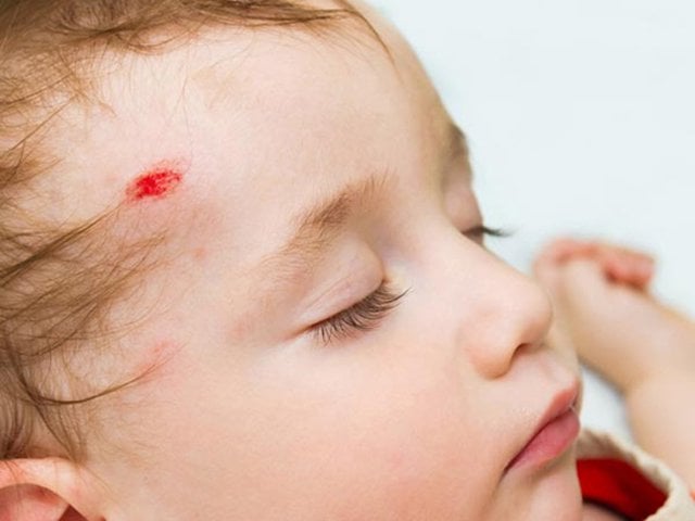 Trẻ 7 tháng tuổi ngã đập đầu xuống đất, có đỏ vùng sau đầu có sao không?