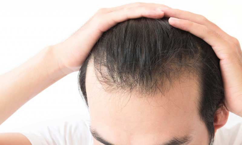 Hói đầu bẩm sinh có thể cấy tóc không?