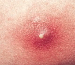 Pimple on Inner Thigh: Causes, Treatments and Prevention Tips