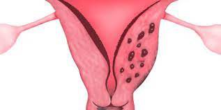 Lòng tử cung có khối echo dày có sao không?