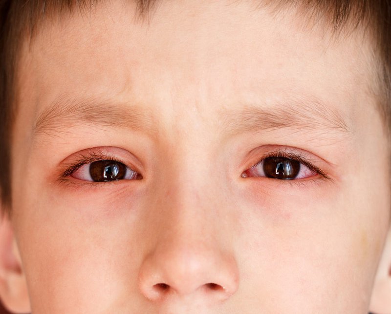 Trẻ bị đau mắt đỏ kèm ngứa kéo dài