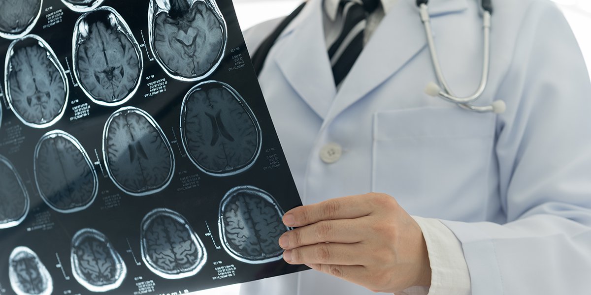 CT-scanner sọ não có thể giúp bác sĩ chẩn đoán đột quỵ