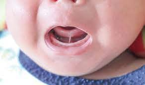 Trẻ 7 tháng thắng lưỡi ngắn độ 3 điều trị thế nào?