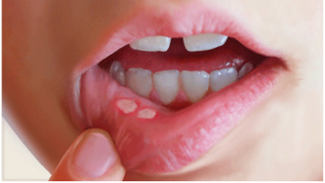 Trẻ niêm mạc miệng, sưng lợi điều trị như thế nào?